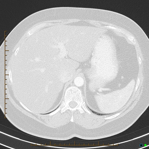 Bronchial diverticula (Radiopaedia 79512-92675 Axial lung window 47).jpg
