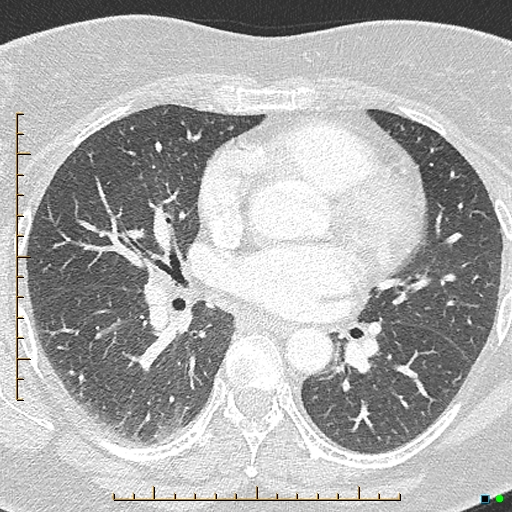 Bronchial diverticula (Radiopaedia 79512-92676 Axial lung window 103).jpg