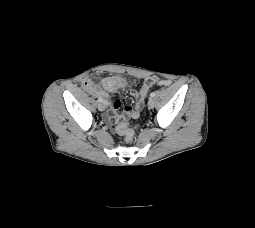 File:Bronchiectasis in Crohn disease (Radiopaedia 60311-67977 B 151).jpg