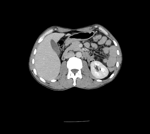 File:Bronchiectasis in Crohn disease (Radiopaedia 60311-67977 B 66).jpg
