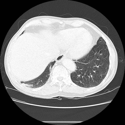 Bronchocele (Radiopaedia 17097-16795 Axial lung window 96).jpg