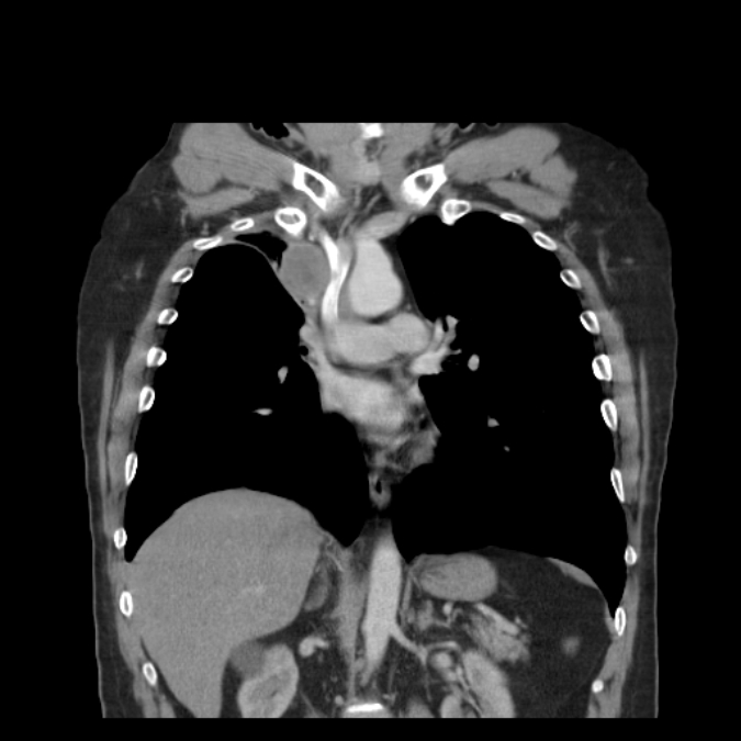 Bronchogenic carcinoma with upper lobe collapse (Radiopaedia 29297-29726 D 30).jpg