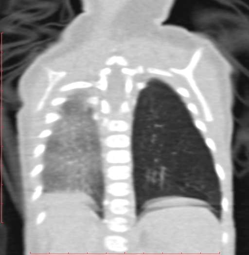 Bronchogenic cyst (Radiopaedia 78599-91409 Coronal lung window 175).jpg