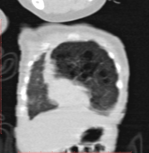 Bronchogenic cyst (Radiopaedia 78599-91409 Coronal lung window 41).jpg