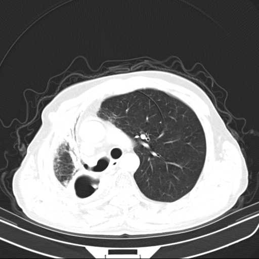 File:Bronchopleural fistula - postoperative complication (Radiopaedia 21020-20947 Axial lung window 20).jpg