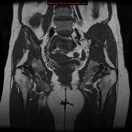 File:Brown tumors (Radiopaedia 9666-10290 Coronal T1 16).jpg