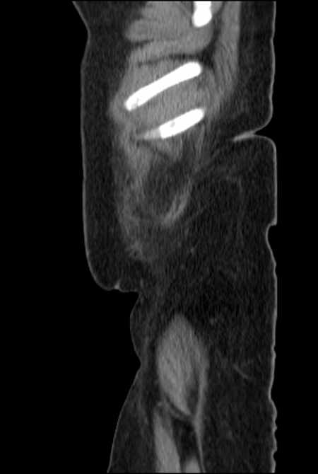 Brown tumors compressing the spinal cord (Radiopaedia 68442-77988 F 4).jpg