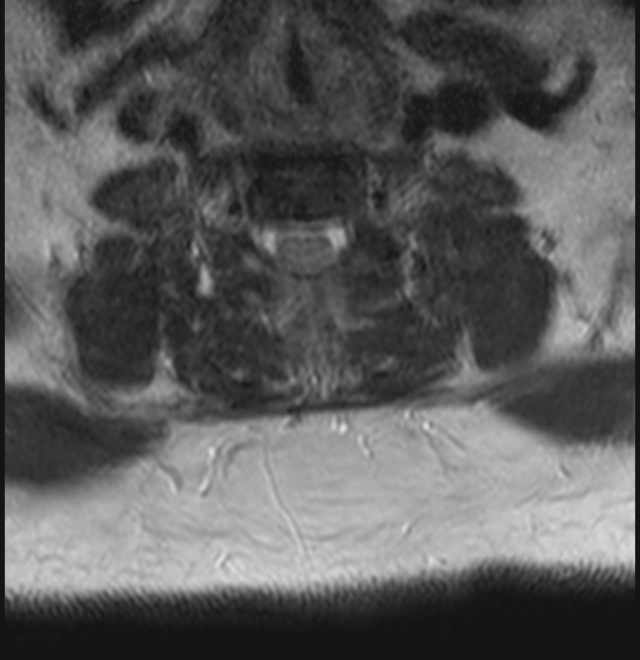 Brown tumors compressing the spinal cord (Radiopaedia 68442-78030 A 60).jpg