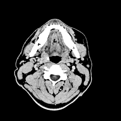 Buccal fat pad arteriovenous malformation (Radiopaedia 70936-81142 Axial non-contrast 11).jpg