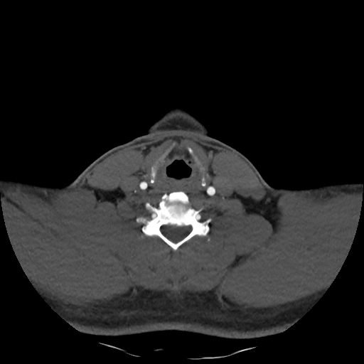 Buccal fat pad arteriovenous malformation (Radiopaedia 70936-81144 A 79).jpg