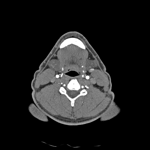 Buccal fat pad arteriovenous malformation (Radiopaedia 70936-81144 D 135).jpg