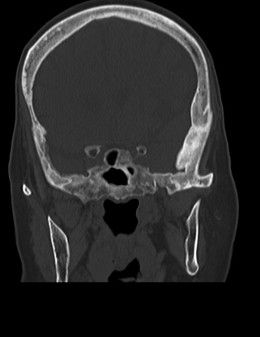 Burnt-out meningioma (Radiopaedia 51557-57337 Coronal bone window 20).jpg