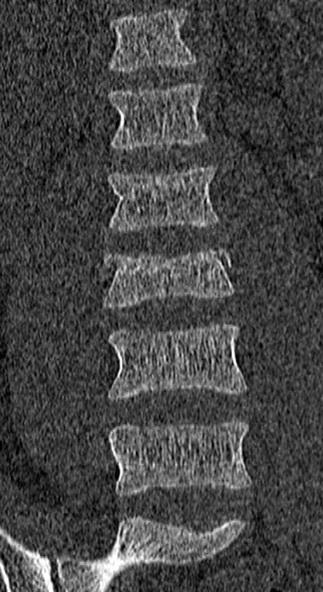 File:Burst fracture (Radiopaedia 53373-59357 Coronal bone window 21).jpg