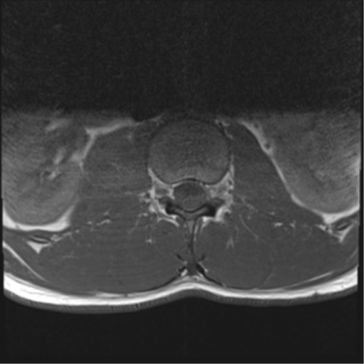 File:Burst fracture - T12 with conus compression (Radiopaedia 56825-63646 Axial T1 5).png