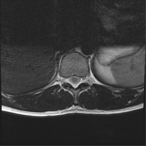 File:Burst fracture - T12 with conus compression (Radiopaedia 56825-63646 Axial T2 25).png