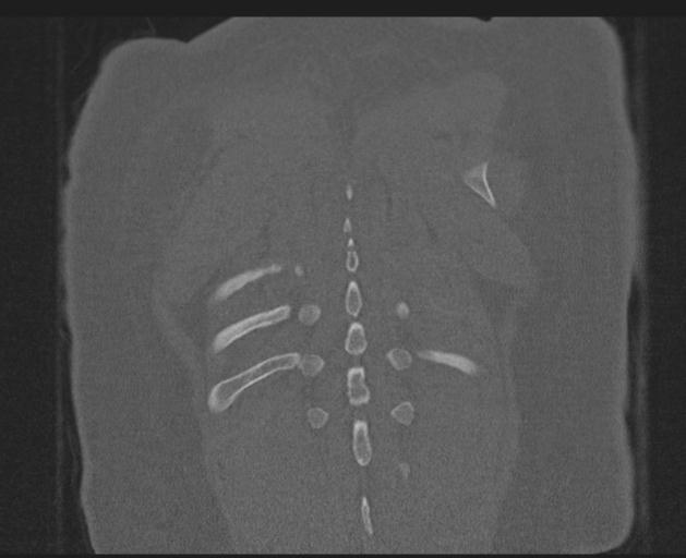 Burst fracture - thoracic spine (Radiopaedia 30238-30865 Coronal bone window 147).jpg