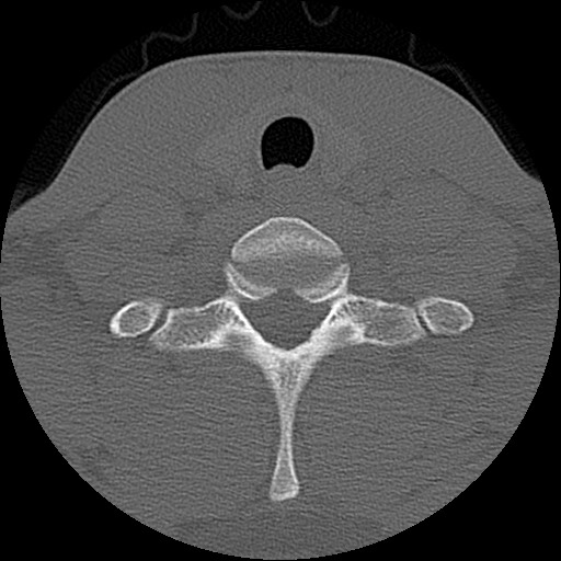 File:C5 facet fracture (Radiopaedia 58374-65499 Axial bone window 77).jpg