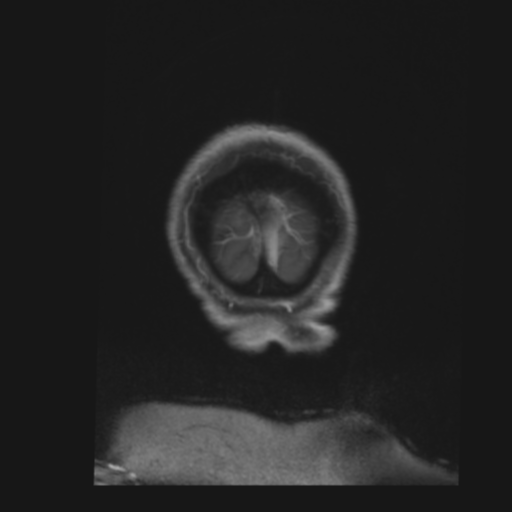 File:CNS lymphoma with steroid response (Radiopaedia 37980-39921 Coronal T1 C+ 52).png