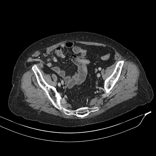 Calcified adrenal glands and Spigelian hernia (Radiopaedia 49741-54988 A 193).jpg