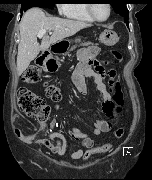 Calcified adrenal glands and Spigelian hernia (Radiopaedia 49741-54988 B 35).jpg