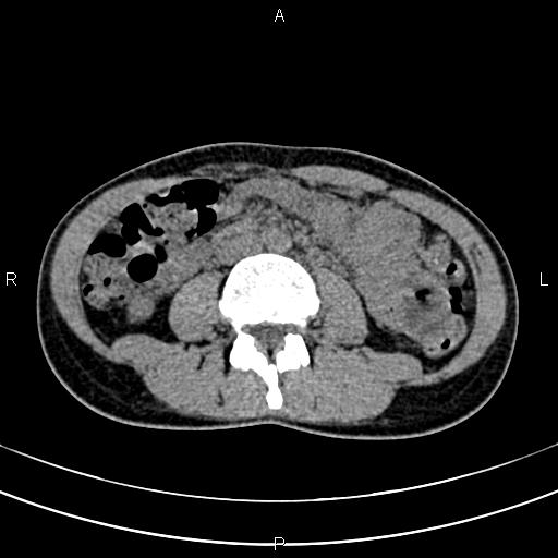 File:Calcified hepatic hydatid cyst (Radiopaedia 83870-99072 Axial non-contrast 97).jpg