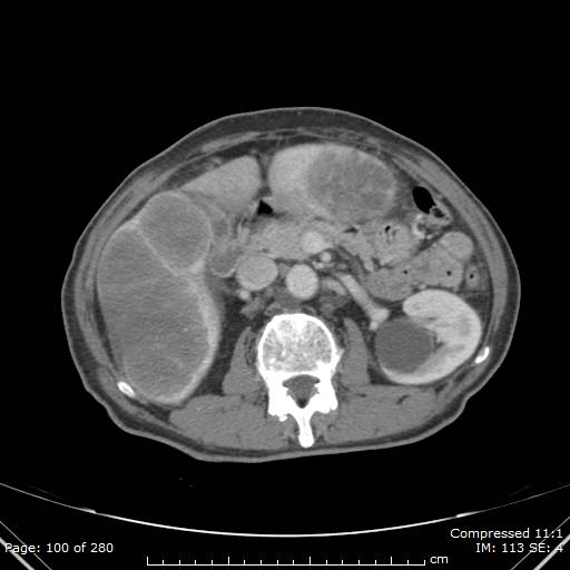 Calcified liver metastases (Radiopaedia 44699-48470 B 36).jpg
