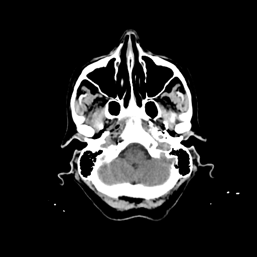 File:Calcified meningioma - cervical canal (Radiopaedia 70136-80171 Axial non-contrast 5).jpg
