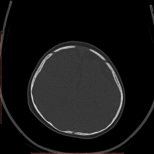 Calcified middle cerebral artery embolism (Radiopaedia 78949-91860 Axial bone window 60).jpg