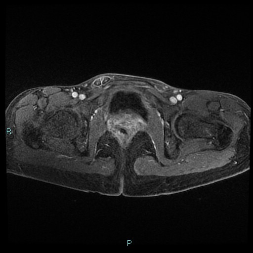 File:Canal of Nuck cyst (Radiopaedia 55074-61448 Axial T1 C+ fat sat 44).jpg