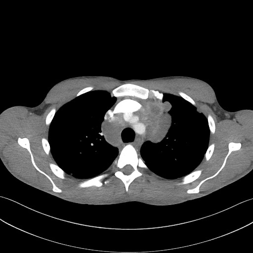 Cannonball metastases - testicular choriocarcinoma (Radiopaedia 84510-99891 B 39).jpg