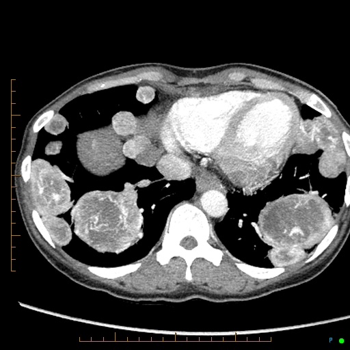 Canonball lung metastasis (Radiopaedia 77634-89837 B 78).jpg