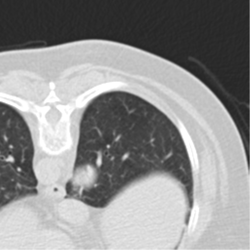 Carcinoid tumor - lung (Radiopaedia 44814-48644 Axial lung window 42).png