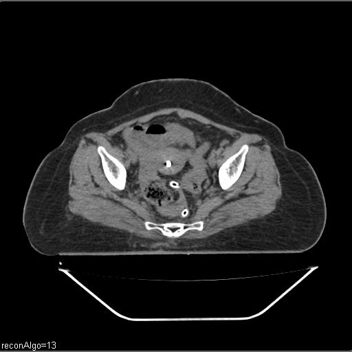 Carcinoma cervix- brachytherapy applicator (Radiopaedia 33135-34173 Axial non-contrast 24).jpg
