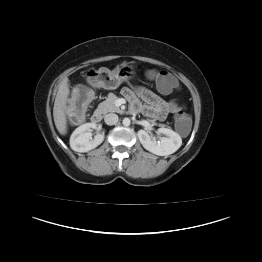 Carcinoma colon - hepatic flexure (Radiopaedia 19461-19493 A 50).jpg