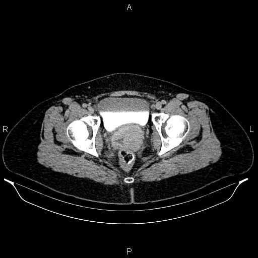 File:Carcinoma of uterine cervix (Radiopaedia 85861-101700 Axial C+ delayed 86).jpg