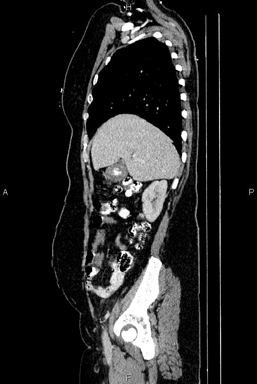 Carcinoma of uterine cervix (Radiopaedia 85861-101700 D 18).jpg