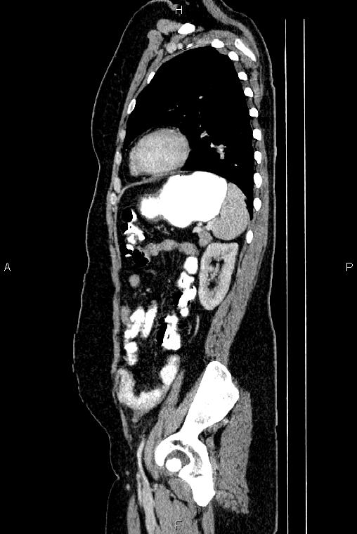 Carcinoma of uterine cervix (Radiopaedia 85861-101700 D 63).jpg