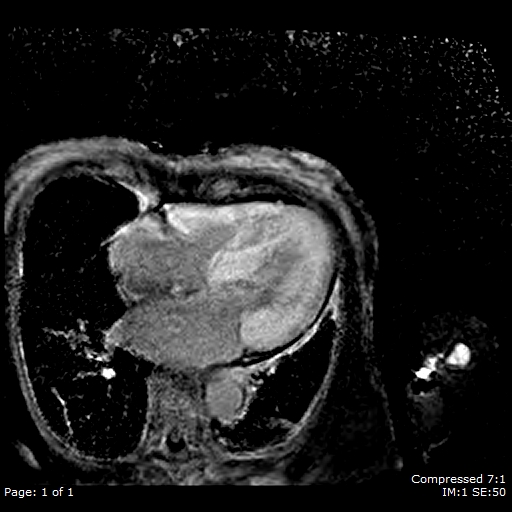 File:Cardiac amyloidosis (Radiopaedia 62017-70102 4ch LGE 1).jpg