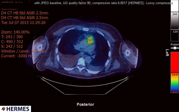 File:Cardiac lymphoma (Radiopaedia 38690-40871 Integrated PET-CT 6).jpg