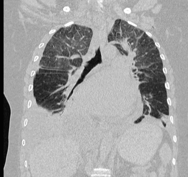 Cardiogenic pulmonary edema (Radiopaedia 29213-29609 Coronal lung window 37).jpg