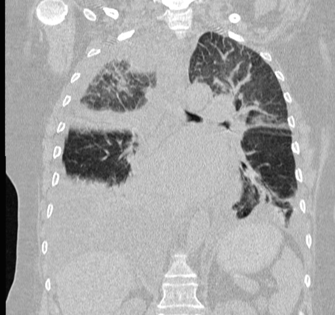 Cardiogenic pulmonary edema (Radiopaedia 29213-29609 Coronal lung window 41).jpg