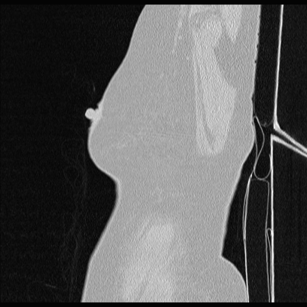 Cardiogenic pulmonary edema (Radiopaedia 29213-29609 Sagittal lung window 2).jpg
