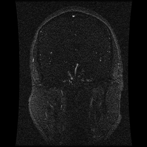 Carotid arterial dissection with acute cerebral infarction (Radiopaedia 26636-26784 MRV 102).jpg