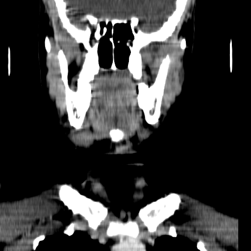 File:Carotid body tumor (Radiopaedia 27890-28124 B 16).jpg