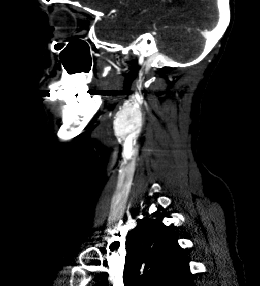 File:Carotid body tumor (Radiopaedia 39845-42300 D 28).jpg