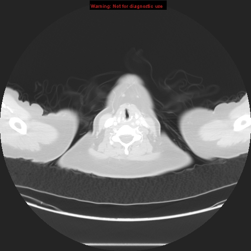 Carotid body tumor with lung metastases (Radiopaedia 9301-48390 Axial lung window 1).jpg