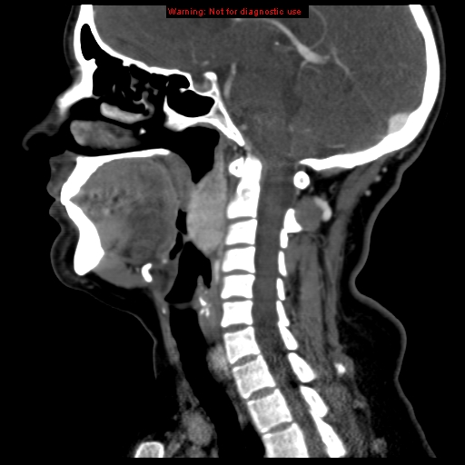 File:Carotid body tumor with lung metastases (Radiopaedia 9301-9986 Sagittal C+ delayed 25).jpg