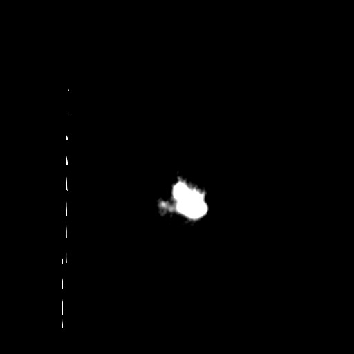 Carotid near-occlusion (Radiopaedia 85304-100887 Coronal non-contrast 75).jpg