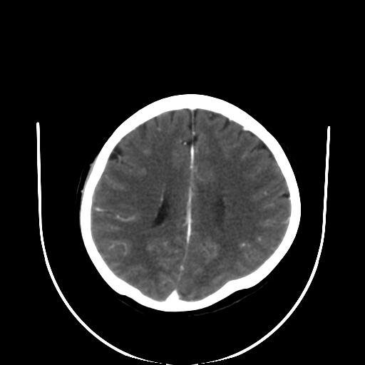 File:Cavernoma with developmental venous anomaly (Radiopaedia 22470-22506 C+ arterial phase 24).jpg