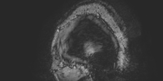 File:Cavernous hemangioma of the cerebellar falx (Radiopaedia 73025-83724 Sagittal BOLD 3).jpg